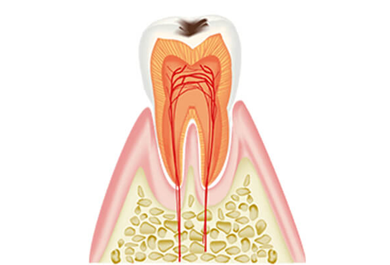 C1：エナメル質の虫歯