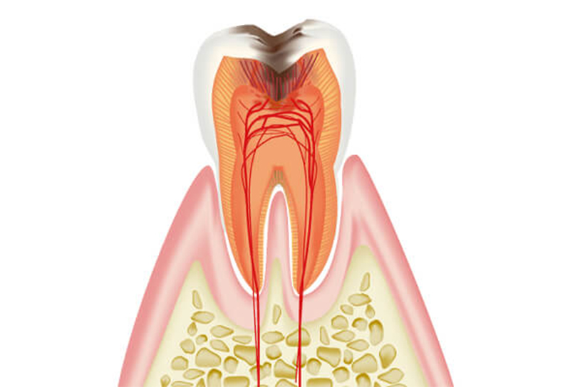 C3：神経まで達した虫歯
